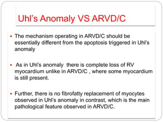 Uhl’s Anomaly VS ARVD/C
 The mechanism operating in ARVD/C should be
essentially different from the apoptosis triggered in Uhl’s
anomaly
 As in Uhl’s anomaly there is complete loss of RV
myocardium unlike in ARVD/C , where some myocardium
is still present.
 Further, there is no fibrofatty replacement of myocytes
observed in Uhl’s anomaly in contrast, which is the main
pathological feature observed in ARVD/C.
 