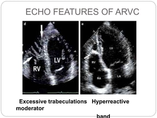 ECHO FEATURES OF ARVC
Excessive trabeculations Hyperreactive
moderator
 