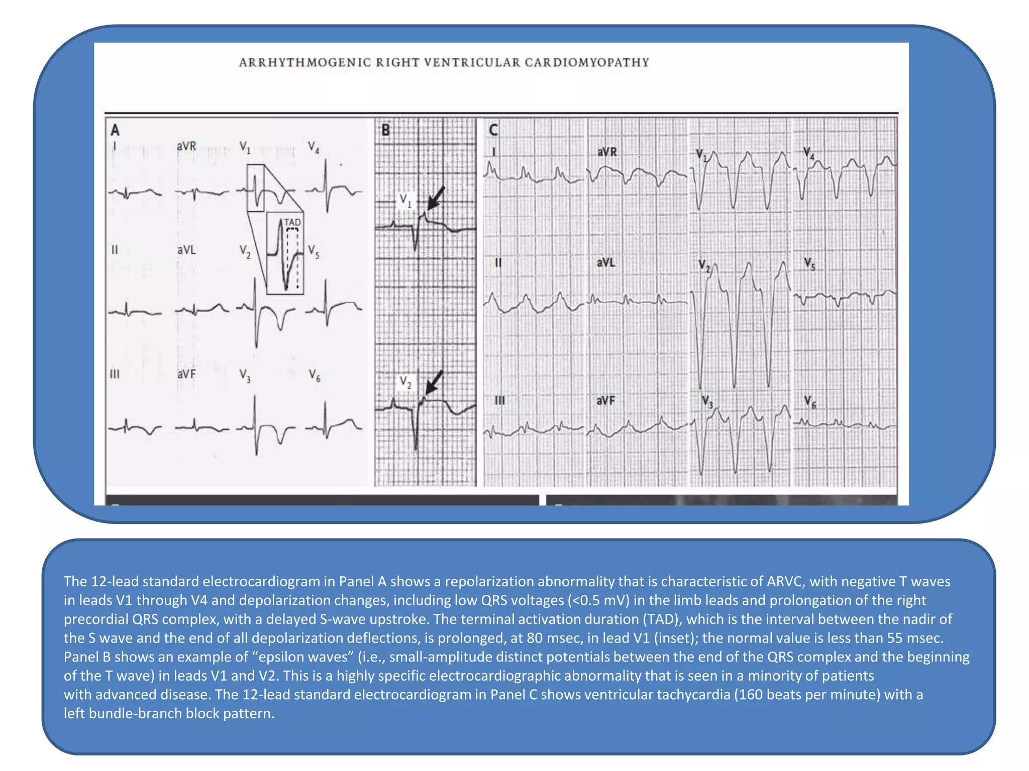 The 12-lead standard electrocardiogram in Panel A shows a repolarization abnormality that is characteristic of ARVC, with negative T waves
in leads V1 through V4 and depolarization changes, including low QRS voltages (<0.5 mV) in the limb leads and prolongation of the right
precordial QRS complex, with a delayed S-wave upstroke. The terminal activation duration (TAD), which is the interval between the nadir of
the S wave and the end of all depolarization deflections, is prolonged, at 80 msec, in lead V1 (inset); the normal value is less than 55 msec.
Panel B shows an example of “epsilon waves” (i.e., small-amplitude distinct potentials between the end of the QRS complex and the beginning
of the T wave) in leads V1 and V2. This is a highly specific electrocardiographic abnormality that is seen in a minority of patients
with advanced disease. The 12-lead standard electrocardiogram in Panel C shows ventricular tachycardia (160 beats per minute) with a
left bundle-branch block pattern.
 