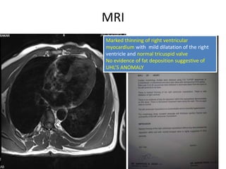 MRI
Marked thinning of right ventricular
myocardium with mild dilatation of the right
ventricle and normal tricuspid valve
No evidence of fat deposition suggestive of
UHL’S ANOMALY
 