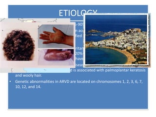 ETIOLOGY
• it is an inherited disorder and 30%-90% of cases are familial .
• OTHER cases, it may result from an acquired etiology such as viral
infection (myocarditis) or unidentified inheritance.
Genetics
• The most common pattern of inheritance is autosomal dominance, with a
variable penetrance ranging from 20%-35% of family members.People
living in the Veneto region of Italy have a higher penetrance.
• The autosomal-recessive (Naxos disease) pattern of inheritance is localized
to the Greek island of Naxos and is associated with palmoplantar keratosis
and wooly hair.
• Genetic abnormalities in ARVD are located on chromosomes 1, 2, 3, 6, 7,
10, 12, and 14.
 