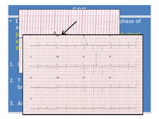 ECG
• ECG findings may be normal in the latent phase of
ARVD, but abnormalities
(depolarization/repolarization and/or conduction)
are seen in most patients upon progression of the
disease .
1. Intraventricular conduction abnormality.
2. T wave abnormalities in presence of right bundle
branch block
3. Anteroseptal T wave inversion.
 