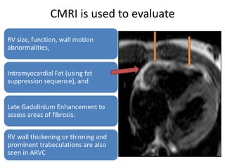 CMRI is used to evaluate
RV size, function, wall motion
abnormalities,
Intramyocardial Fat (using fat
suppression sequence), and
Late Gadolinium Enhancement to
assess areas of fibrosis.
RV wall thickening or thinning and
prominent trabeculations are also
seen in ARVC
 