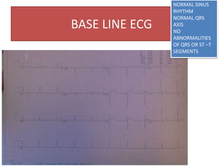 BASE LINE ECG
NORMAL SINUS
RHYTHM
NORMAL QRS
AXIS
NO
ABNORMALITIES
OF QRS OR ST –T
SEGMENTS
 