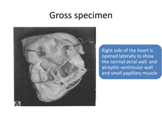 Gross specimen
Right side of the heart is
opened laterally to show
the normal atrial wall and
atrophic ventricular wall
and small papillary muscle
 