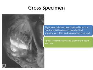 Gross Specimen
Right Ventricle has been opened from the
front and is illuminated from behind
showing very thin and translucent free wall.
Apical trabeculations and papillary muscle
are thin
 