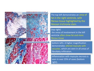 The top left demonstrates an area of
fat in the right ventricle, with
fibrous tissue highlighted by the
Masson trichrome stain.
(top right)
the areas of involvement in the left
ventricle often show fat and more
fibrous tissue
bottom left). A higher magnification
demonstrates altered myocyte with
vacuoles, which are seen in all areas of
fibrofatty infiltration.
Inflammation with myocyte necrosis is
seen in over 25% of cases (bottom
right).
 