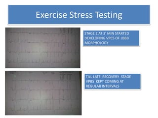 Exercise Stress Testing
STAGE 2 AT 3’ MIN STARTED
DEVELOPING VPCS OF LBBB
MORPHOLOGY
TILL LATE RECOVERY STAGE
VPBS KEPT COMING AT
REGULAR INTERVALS
 