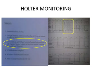 HOLTER MONITORING
 