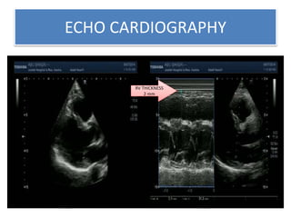 ECHO CARDIOGRAPHY
RV THICKNESS
2 mm
 