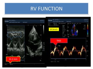 RV FUNCTION
21.2 mm
10.3cm/s
TAPSE
TASE
 