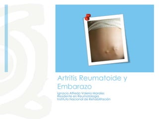 Artritis Reumatoide y
Embarazo
Ignacio Alfredo Valerio Morales
Residente en Reumatología
Instituto Nacional de Rehabilitación
 