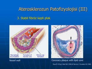 Aterosklerozun Patofizyolojisi (III)
         3. Stabil fibröz kepli plak




Macrophage     Formation of    Fibrous cap
accumulation   necrotic core    formation

Vessel wall                                  Coronary plaque with lipid core
                                              Ross R, N Engl J Med 340 (1999) & Falk et al., Circulation 92 (1995)
 