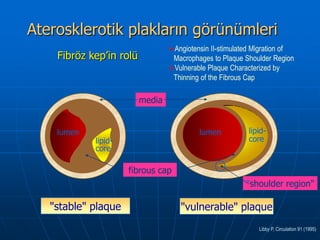 Aterosklerotik plakların görünümleri
                                 Angiotensin II-stimulated Migration of
    Fibröz kep’in rolü            Macrophages to Plaque Shoulder Region
                                 Vulnerable Plaque Characterized by
                                  Thinning of the Fibrous Cap

                         media


    lumen                                 lumen          lipid-
            lipid-                                       core
            core

                     fibrous cap
                                                         "shoulder region"

   "stable" plaque                  "vulnerable" plaque
                                                             Libby P, Circulation 91 (1995)
 