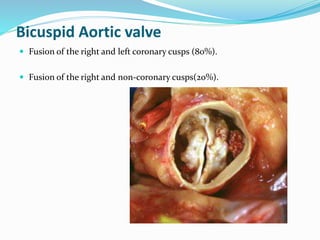 Bicuspid Aortic valve
 Fusion of the right and left coronary cusps (80%).
 Fusion of the right and non-coronary cusps(20%).
 