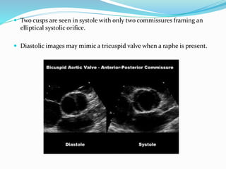  Two cusps are seen in systole with only two commissures framing an
elliptical systolic orifice.
 Diastolic images may mimic a tricuspid valve when a raphe is present.
 