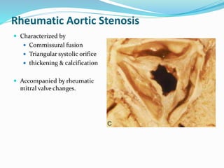 Rheumatic Aortic Stenosis
 Characterized by
 Commissural fusion
 Triangular systolic orifice
 thickening & calcification
 Accompanied by rheumatic
mitral valve changes.
 