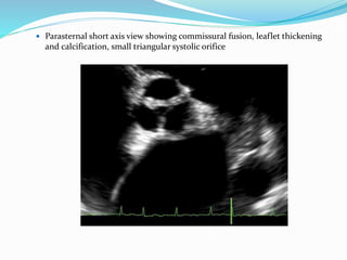  Parasternal short axis view showing commissural fusion, leaflet thickening
and calcification, small triangular systolic orifice
 