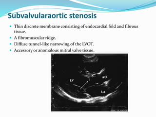 Subvalvularaortic stenosis
 Thin discrete membrane consisting of endocardial fold and fibrous
tissue.
 A fibromuscular ridge.
 Diffuse tunnel-like narrowing of the LVOT.
 Accessory or anomalous mitral valve tissue.
 