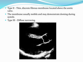  Type II - Thin, discrete fibrous membrane located above the aortic
valve.
 The membrane usually mobile and may demonstrate doming during
systole.
 Type III - Diffuse narrowing.
 