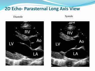 2D Echo- Parasternal Long Axis View
Diastole Systole
 
