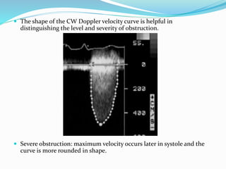  The shape of the CW Doppler velocity curve is helpful in
distinguishing the level and severity of obstruction.
 Severe obstruction: maximum velocity occurs later in systole and the
curve is more rounded in shape.
 