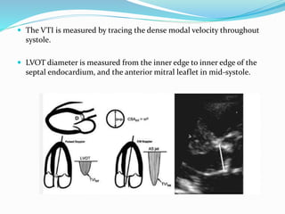  The VTI is measured by tracing the dense modal velocity throughout
systole.
 LVOT diameter is measured from the inner edge to inner edge of the
septal endocardium, and the anterior mitral leaflet in mid-systole.
 