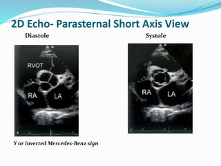 2D Echo- Parasternal Short Axis View
Diastole Systole
Y or inverted Mercedes-Benz sign
 