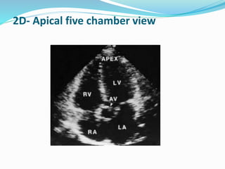 2D- Apical five chamber view
 
