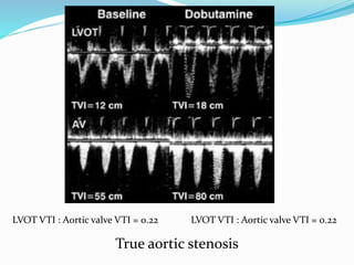 LVOT VTI : Aortic valve VTI = 0.22 LVOT VTI : Aortic valve VTI = 0.22
True aortic stenosis
 