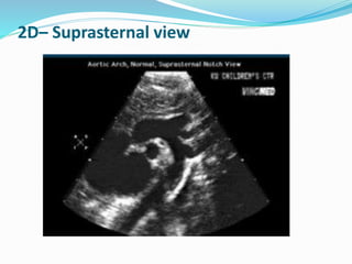 2D– Suprasternal view
 