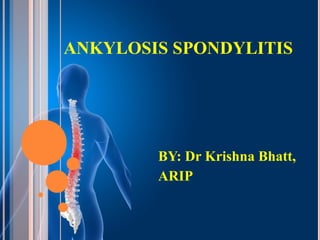 ANKYLOSIS SPONDYLITIS
BY: Dr Krishna Bhatt,
ARIP
 