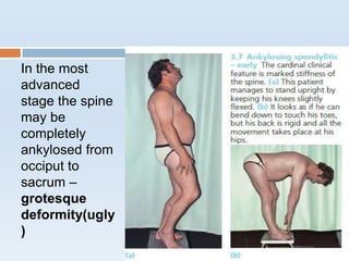 In the most
advanced
stage the spine
may be
completely
ankylosed from
occiput to
sacrum –
grotesque
deformity(ugly
)
 