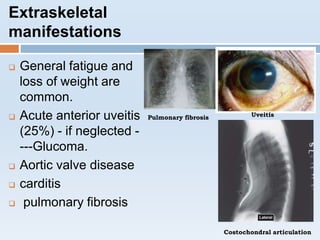 Extraskeletal
manifestations
 General fatigue and
loss of weight are
common.
 Acute anterior uveitis
(25%) - if neglected -
---Glucoma.
 Aortic valve disease
 carditis
 pulmonary fibrosis
Pulmonary fibrosis Uveitis
Costochondral articulation
 