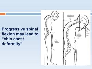 Progressive spinal
flexion may lead to
“chin chest
deformity”
 