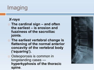 Imaging
X-rays
 The cardinal sign – and often
the earliest – is erosion and
fuzziness of the sacroiliac
joints.
 The earliest vertebral change is
flattening of the normal anterior
concavity of the vertebral body
(‘squaring’).
 Osteoporosis is common in
longstanding cases ---
hyperkyphosis of the thoracic
spine.
 