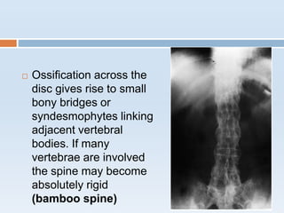  Ossification across the
disc gives rise to small
bony bridges or
syndesmophytes linking
adjacent vertebral
bodies. If many
vertebrae are involved
the spine may become
absolutely rigid
(bamboo spine)
 