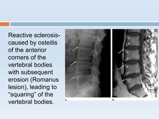 Reactive sclerosis-
caused by osteitis
of the anterior
corners of the
vertebral bodies
with subsequent
erosion (Romanus
lesion), leading to
“squaring” of the
vertebral bodies.
 