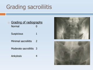 Grading sacroiliitis
 Grading of radiographs
Normal 0
Suspicious 1
Minimal sacroiliitis 2
Moderate sacroiliitis 3
Ankylosis 4
 