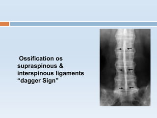 Ossification os
supraspinous &
interspinous ligaments
“dagger Sign”
 