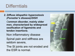 Differntials
2. Diffuse idiopathic hyperostosis
(Forestier’s disease)/DISH
Common disorder, mainly older
men, characterized by widespread
ossification of ligaments and
tendon insertions.
Non inflammatory disease
Spinal pain and stiffness are
seldom severe,
The SI joints are not eroded and
the ESR is normal.
 