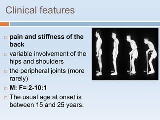 Clinical features
 pain and stiffness of the
back
 variable involvement of the
hips and shoulders
 the peripheral joints (more
rarely)
 M: F= 2-10:1
 The usual age at onset is
between 15 and 25 years.
 