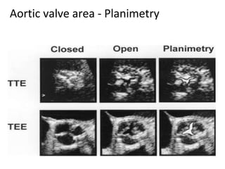 Aortic valve area - Planimetry
 
