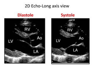 2D Echo-Long axis view
Diastole Systole
 