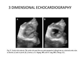 3 DIMENSIONAL ECHOCARDIOGRAPHY
 