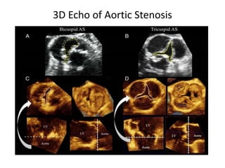 3D Echo of Aortic Stenosis
 