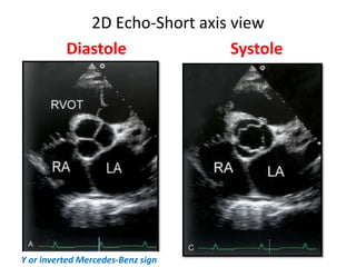 2D Echo-Short axis view
Diastole Systole
Y or inverted Mercedes-Benz sign
 