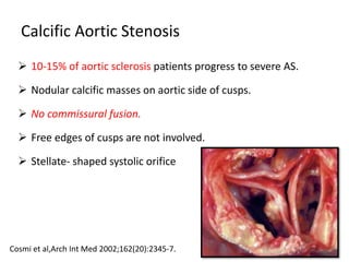 Calcific Aortic Stenosis
 10-15% of aortic sclerosis patients progress to severe AS.
 Nodular calcific masses on aortic side of cusps.
 No commissural fusion.
 Free edges of cusps are not involved.
 Stellate- shaped systolic orifice
Cosmi et al,Arch Int Med 2002;162(20):2345-7.
 