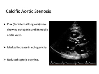 Calcific Aortic Stenosis
 Plax (Parasternal long axis) view
showing echogenic and immobile
aortic valve.
 Marked increase in echogenicity.
 Reduced systolic opening.
 