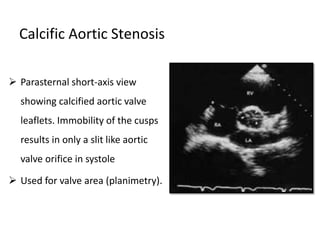Calcific Aortic Stenosis
 Parasternal short-axis view
showing calcified aortic valve
leaflets. Immobility of the cusps
results in only a slit like aortic
valve orifice in systole
 Used for valve area (planimetry).
 